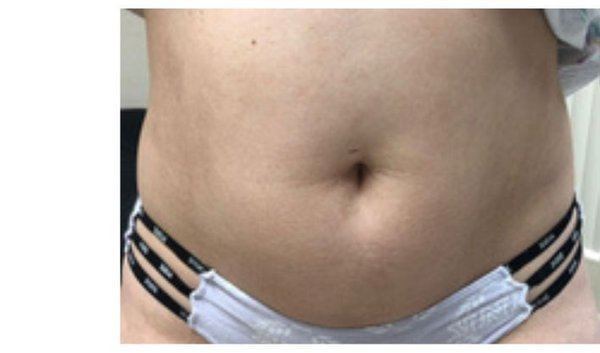 Avant cryolipolyse ventre